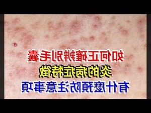 陰毛 毛囊炎